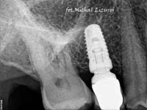 implanty