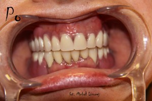 metamorfozy - zębów
